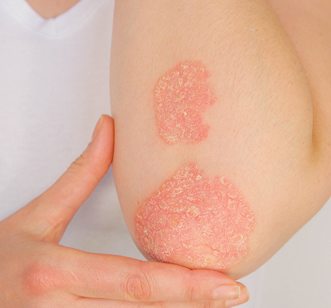 Psoriasisartrit - Armbåge med psoriasis plack