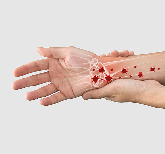 Reumatoid artrit. Hand drabbad av reumatism
